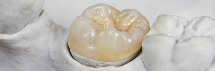 vancouver dental crowns